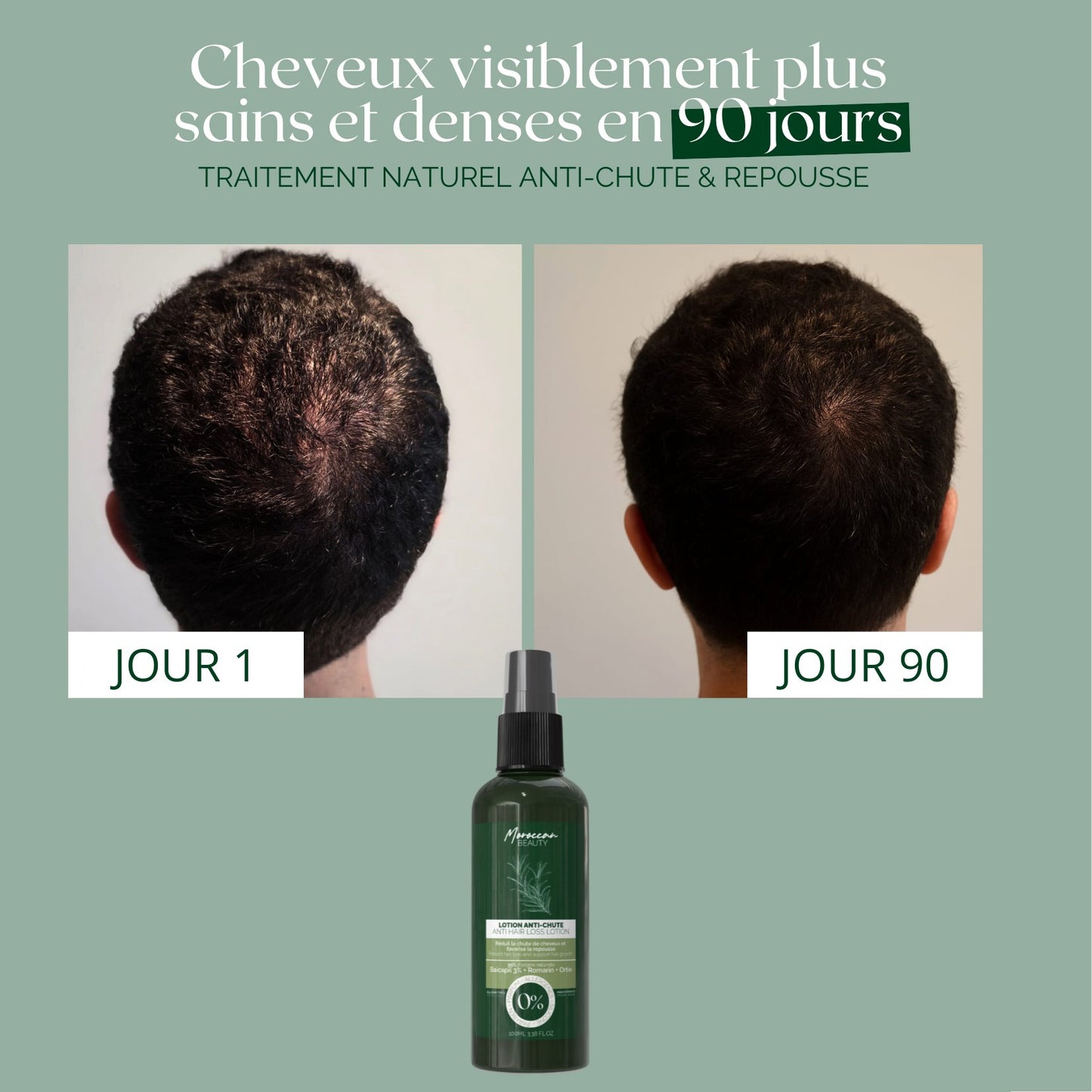 Natural Anti-Hair Loss & Hair Regrowth Lotion – 3% Baicapil + Rosemary – 90-Day Treatment | 100 ml