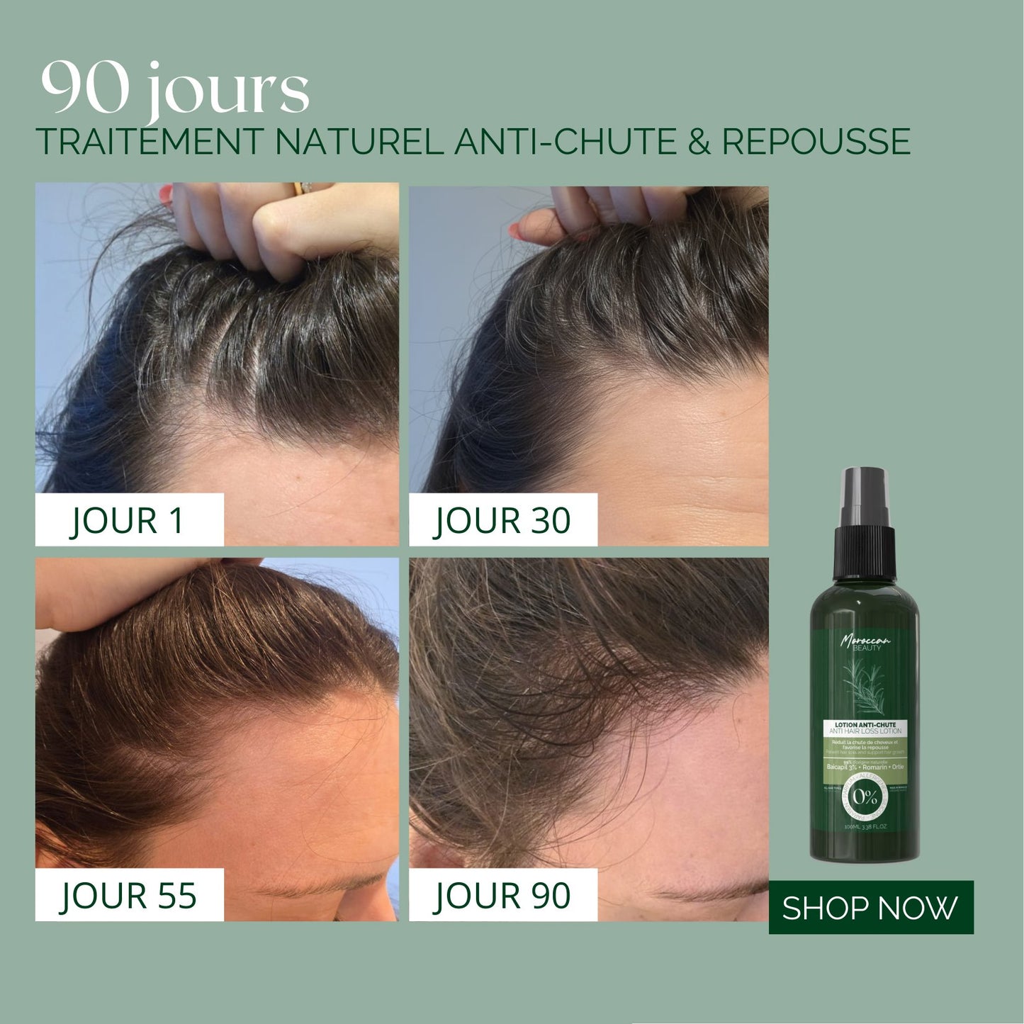 Natural Anti-Hair Loss & Hair Regrowth Lotion – 3% Baicapil + Rosemary – 90-Day Treatment | 100 ml